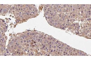 ABIN6278711 at 1/100 staining Human liver cancer tissue by IHC-P. (CD52 抗体)