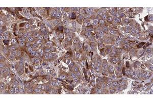 ABIN6277713 at 1/100 staining Human liver cancer tissue by IHC-P. (ATP1B1 抗体  (Internal Region))