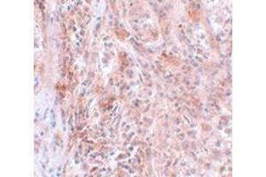 Immunohistochemical staining of human breast cancer tissue with BCAS2 polyclonal antibody  at 5 ug/mL dilution. (BCAS2 抗体  (C-Term))