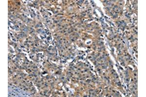 The image on the left is immunohistochemistry of paraffin-embedded Human gastric cancer tissue using ABIN7191907(PLA2G6 Antibody) at dilution 1/15, on the right is treated with synthetic peptide. (PLA2G6 抗体)
