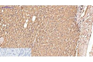 Immunohistochemistry of paraffin-embedded Human liver cancer tissue using IDE Monoclonal Antibody at dilution of 1:200. (IDE 抗体)