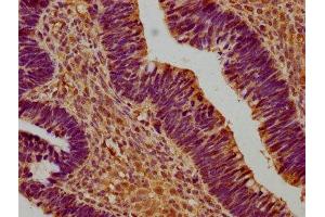 IHC image of ABIN7171036 diluted at 1:300 and staining in paraffin-embedded human ovarian cancer performed on a Leica BondTM system. (SUSD5 抗体  (AA 46-287))