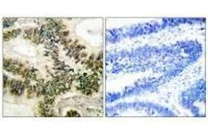 Immunohistochemical analysis of paraffin-embedded human colon carcinoma tissue using Cyclin E1 (Ab-395) antibody. (Cyclin E1 抗体  (Thr395))