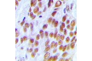 Immunohistochemical analysis of KDM1A staining in human breast cancer formalin fixed paraffin embedded tissue section. (LSD1 抗体)