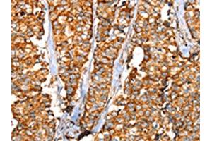 The image on the left is immunohistochemistry of paraffin-embedded Human breast cancer tissue using ABIN7192442(SLC25A3 Antibody) at dilution 1/35, on the right is treated with synthetic peptide. (SLC25A3 抗体)