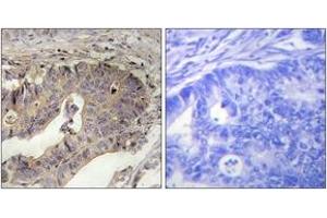 Immunohistochemistry analysis of paraffin-embedded human breast carcinoma tissue, using Fibrillin-1 Antibody. (Fibrillin 1 抗体  (AA 2811-2860))