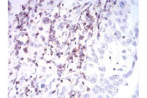 Immunohistochemical analysis of paraffin-embedded endometrial cancer tissues using CD2 mouse mAb with DAB staining.