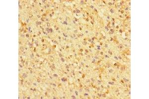 Immunohistochemistry of paraffin-embedded human glioma using ABIN7176271 at dilution of 1:100 (ZNF384 抗体  (AA 1-245))