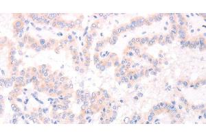 Immunohistochemistry of paraffin-embedded Human thyroid cancer tissue using AMH Polyclonal Antibody at dilution 1:30 (AMH 抗体)