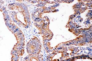 Anti-SMAD5 antibody, IHC(P) IHC(P): Human Intestinal Cancer Tissue (SMAD5 抗体  (Middle Region))