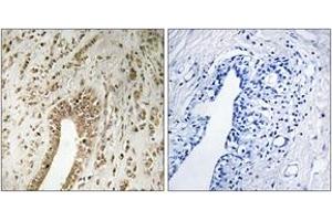 Immunohistochemistry analysis of paraffin-embedded human breast carcinoma tissue, using PHF3 Antibody. (PHF3 抗体  (AA 1990-2039))