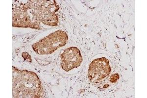 Expression of NTSR1 in human breast cancer - Immunohistochemical staining of human breast cancer cells using Anti-Neurotensin Receptor 1 (extracellular) Antibody (ABIN7043383, ABIN7044767 and ABIN7044768), (1:100). (NTSR1 抗体  (2nd Extracellular Loop))