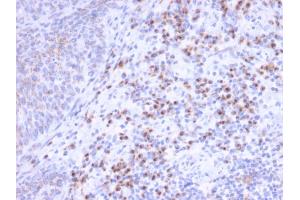 Formalin-fixed, paraffin-embedded human Unknown Tumor stained with RCAS1 Mouse Monoclonal Antibody (CPTC-EBAG9-1). (RCAS1 抗体)