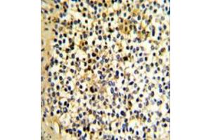 Formalin-Fixed, Paraffin-Embedded Human kidney carcinoma stained with DCXR Antibody (Center) followed which was peroxidase-conjugated to the secondary antibody, followed by DAB staining. (DCXR 抗体  (Middle Region))