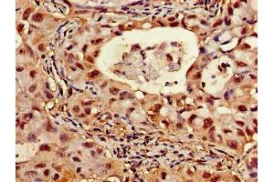 Immunohistochemistry of paraffin-embedded human lung cancer using ABIN7144848 at dilution of 1:100 (ATP5F1D 抗体  (AA 23-168))