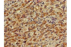 Immunohistochemistry of paraffin-embedded human liver cancer using ABIN7146606 at dilution of 1:100 (PRKACG 抗体  (Catalytic Subunit gamma))