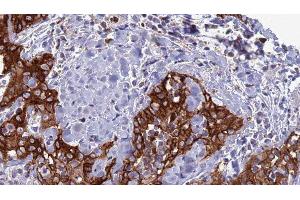 ABIN6277316 at 1/100 staining Human Head and neck cancer tissue by IHC-P. (CLEC4D 抗体  (Internal Region))
