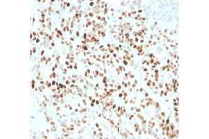 Formalin fixed paraffin embedded human colon carcinoma stained with p21 Rabbit Recombinant Monoclonal Antibody (CIP1/4377R). (Recombinant p21 抗体  (AA 1-100))
