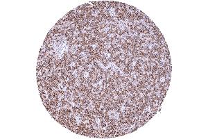 Diffuse large B cell lymphoma with strong CD32b staining of tumor cells
