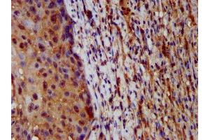 IHC image of ABIN7155245 diluted at 1:200 and staining in paraffin-embedded human lung cancer performed on a Leica BondTM system. (HAL 抗体  (AA 36-152))