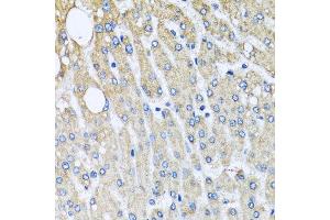 Immunohistochemistry of paraffin-embedded human liver injury using UQCRC2 antibody at dilution of 1:100 (x40 lens). (UQCRC2 抗体)