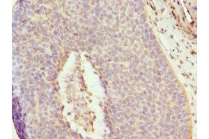 Immunohistochemistry of paraffin-embedded human cervical cancer using ABIN7150033 at dilution of 1:100 (DAAM2 抗体  (AA 1-86))