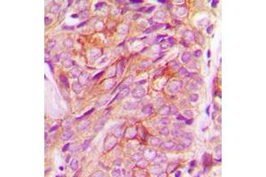 Immunohistochemical analysis of GRASP55 staining in human breast cancer formalin fixed paraffin embedded tissue section. (GORASP2 抗体  (Center))