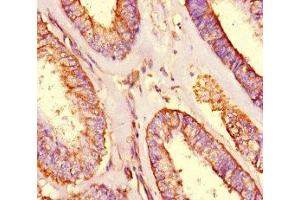 Immunohistochemistry of paraffin-embedded human endometrial cancer using ABIN7166128 at dilution of 1:100 (SHROOM3 抗体  (AA 1309-1571))