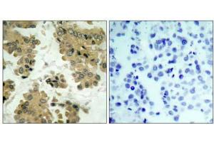 Immunohistochemical analysis of paraffin-embedded human lung carcinoma tissue using Akt2 (Ab-474) antibody (E021155). (AKT2 抗体)