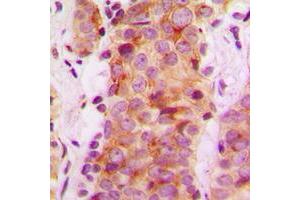 Immunohistochemical analysis of Rabaptin 5 beta staining in human breast cancer formalin fixed paraffin embedded tissue section. (RABEP2 抗体  (Center))