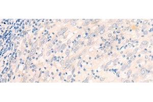Immunohistochemistry of paraffin-embedded Human cervical cancer tissue using EME2 Polyclonal Antibody at dilution of 1:40(x200) (EME2 抗体)