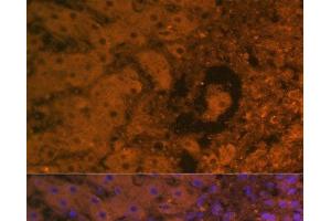 Immunofluorescence analysis of Human liver cancer using AFP Monoclonal Antibody at dilution of 1:100. (alpha Fetoprotein 抗体)