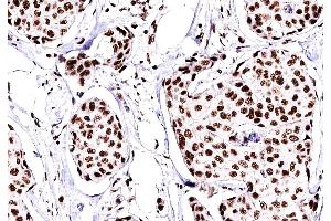 ABIN6269094 at 1/200 staining human Breast cancer tissue sections by IHC-P. (C-JUN 抗体  (N-Term))