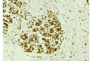 ABIN6277540 at 1/100 staining Human breast cancer tissue by IHC-P. (NEK2 抗体  (Internal Region))