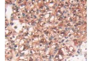IHC-P analysis of Human Kidney Cancer Tissue, with DAB staining. (PYGL 抗体  (AA 370-538))