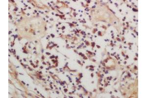 Formalin-fixed and paraffin embedded human lung carcinoma labeled with Rabbit Anti-CSK (Ser364) Polyclonal Antibody, Unconjugated  at 1:200 followed by conjugation to the secondary antibody and DAB staining (CSK 抗体  (pSer364))