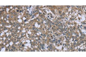 Immunohistochemistry of paraffin-embedded Human cervical cancer using PTK2B Polyclonal Antibody at dilution of 1:50 (PTK2B 抗体)