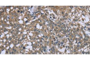 Immunohistochemistry of paraffin-embedded Human cervical cancer using PTK2B Polyclonal Antibody at dilution of 1:50 (PTK2B 抗体)