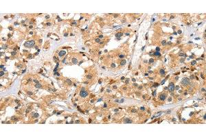 Immunohistochemistry of paraffin-embedded Human thyroid cancer using Cathepsin E Polyclonal Antibody at dilution of 1:40 (Cathepsin E 抗体)