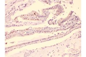 IHC testing of FFPE human intestinal carcinoma with HDGF antibody at 1ug/ml. (HDGF 抗体  (AA 61-97))