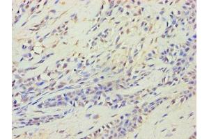 Immunohistochemistry of paraffin-embedded human breast cancer using ABIN7164537 at dilution of 1:100 (HARS2 抗体  (AA 34-506))