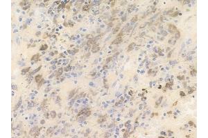 ABIN6255002 and ABIN6266460 at 1/100 staining human melanoma by IHC-P. (PAK3 抗体  (pSer154))