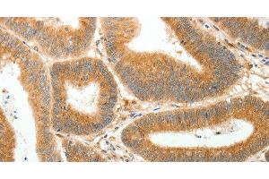 Immunohistochemistry of paraffin-embedded Human colon cancer using AKR1B1 Polyclonal Antibody at dilution of 1:30 (AKR1B1 抗体)