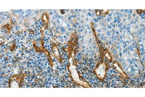 Immunohistochemistry of paraffin-embedded Human cervical cancer using CAV1 Polyclonal Antibody at dilution of 1:40