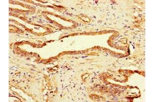 Immunohistochemistry of paraffin-embedded human prostate cancer using ABIN7158768 at dilution of 1:100 (GAA 抗体  (AA 601-952))