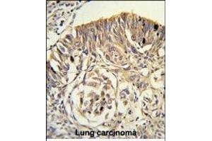 Formalin-fixed and paraffin-embedded human lung carcinoma reacted with PLTP Antibody (C-term), which was peroxidase-conjugated to the secondary antibody, followed by DAB staining. (PLTP 抗体  (C-Term))