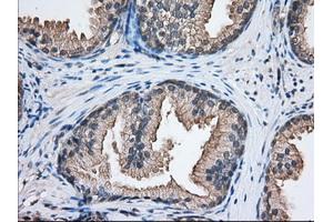 Immunohistochemical staining of paraffin-embedded Human liver tissue using anti-NXNL2 mouse monoclonal antibody. (NXNL2 抗体)
