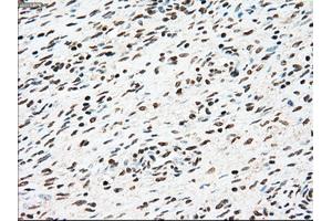 Immunohistochemical staining of paraffin-embedded Adenocarcinoma of colon tissue using anti-SSBmouse monoclonal antibody. (SSB 抗体)