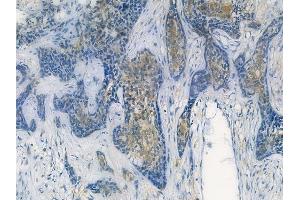ABIN7093817 and ABIN7097860 at 1/100 staining human breast carcinoma by IHC-P. (CXCL2 抗体  (C-Term))