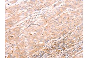 The image on the left is immunohistochemistry of paraffin-embedded Human esophagus cancer tissue using ABIN7189783(ALPPL2 Antibody) at dilution 1/20, on the right is treated with synthetic peptide. (ALPPL2 抗体)
